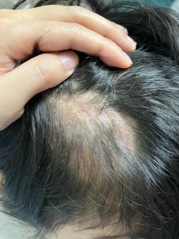 宁波5岁女童头上长出大脓包，致永久性脱发！医生：养宠物的要注意